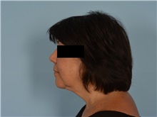 Facial Feminization After Photo by Ellen Janetzke, MD; Bloomfield Hills, MI - Case 50934