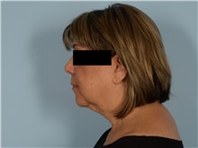 Facial Feminization Before Photo by Ellen Janetzke, MD; Bloomfield Hills, MI - Case 50934