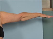 Arm Lift After Photo by Ellen Janetzke, MD; Bloomfield Hills, MI - Case 50932