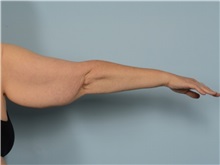 Arm Lift Before Photo by Ellen Janetzke, MD; Bloomfield Hills, MI - Case 50932
