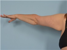 Arm Lift After Photo by Ellen Janetzke, MD; Bloomfield Hills, MI - Case 50932