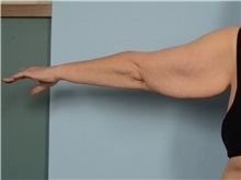 Arm Lift Before Photo by Ellen Janetzke, MD; Bloomfield Hills, MI - Case 50932