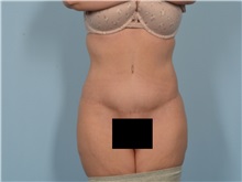 Tummy Tuck After Photo by Ellen Janetzke, MD; Bloomfield Hills, MI - Case 50929