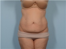 Tummy Tuck Before Photo by Ellen Janetzke, MD; Bloomfield Hills, MI - Case 50929