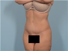 Tummy Tuck After Photo by Ellen Janetzke, MD; Bloomfield Hills, MI - Case 50929