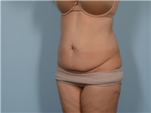 Tummy Tuck Before Photo by Ellen Janetzke, MD; Bloomfield Hills, MI - Case 50929
