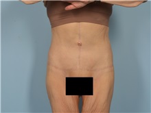 Tummy Tuck After Photo by Ellen Janetzke, MD; Bloomfield Hills, MI - Case 50926