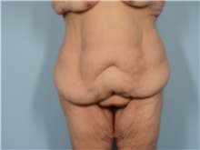 Tummy Tuck Before Photo by Ellen Janetzke, MD; Bloomfield Hills, MI - Case 50926