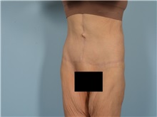 Tummy Tuck After Photo by Ellen Janetzke, MD; Bloomfield Hills, MI - Case 50926