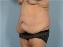 Tummy Tuck Before Photo by Ellen Janetzke, MD; Bloomfield Hills, MI - Case 50926