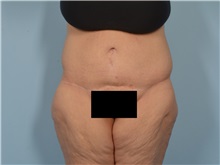 Tummy Tuck After Photo by Ellen Janetzke, MD; Bloomfield Hills, MI - Case 50930