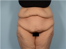 Tummy Tuck Before Photo by Ellen Janetzke, MD; Bloomfield Hills, MI - Case 50930