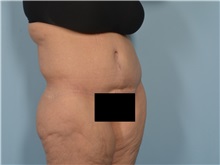 Tummy Tuck After Photo by Ellen Janetzke, MD; Bloomfield Hills, MI - Case 50930