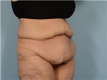 Tummy Tuck Before Photo by Ellen Janetzke, MD; Bloomfield Hills, MI - Case 50930