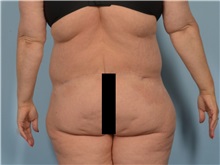 Body Lift After Photo by Ellen Janetzke, MD; Bloomfield Hills, MI - Case 50931