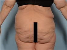 Body Lift Before Photo by Ellen Janetzke, MD; Bloomfield Hills, MI - Case 50931