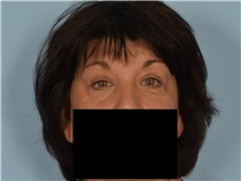 Eyelid Surgery After Photo by Ellen Janetzke, MD; Bloomfield Hills, MI - Case 50933