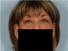 Eyelid Surgery Before Photo by Ellen Janetzke, MD; Bloomfield Hills, MI - Case 50933