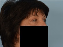 Eyelid Surgery After Photo by Ellen Janetzke, MD; Bloomfield Hills, MI - Case 50933