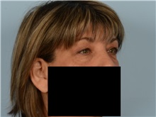 Eyelid Surgery Before Photo by Ellen Janetzke, MD; Bloomfield Hills, MI - Case 50933
