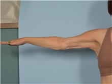 Arm Lift After Photo by Ellen Janetzke, MD; Bloomfield Hills, MI - Case 50927