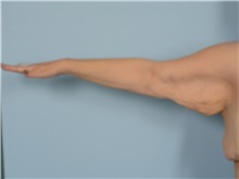 Arm Lift Before Photo by Ellen Janetzke, MD; Bloomfield Hills, MI - Case 50927