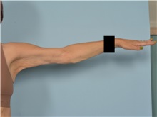 Arm Lift After Photo by Ellen Janetzke, MD; Bloomfield Hills, MI - Case 50927