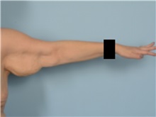Arm Lift Before Photo by Ellen Janetzke, MD; Bloomfield Hills, MI - Case 50927