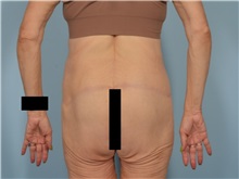 Body Lift After Photo by Ellen Janetzke, MD; Bloomfield Hills, MI - Case 50928