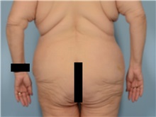 Body Lift Before Photo by Ellen Janetzke, MD; Bloomfield Hills, MI - Case 50928