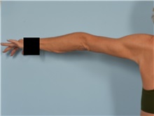 Arm Lift After Photo by Ellen Janetzke, MD; Bloomfield Hills, MI - Case 50967