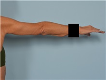 Arm Lift After Photo by Ellen Janetzke, MD; Bloomfield Hills, MI - Case 50967
