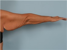 Arm Lift Before Photo by Ellen Janetzke, MD; Bloomfield Hills, MI - Case 50967