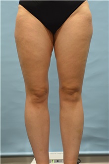 Thigh Lift After Photo by Ellen Janetzke, MD; Bloomfield Hills, MI - Case 51451