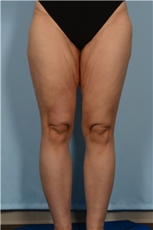 Thigh Lift Before Photo by Ellen Janetzke, MD; Bloomfield Hills, MI - Case 51451