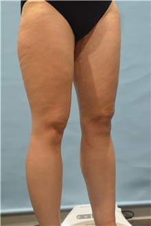 Thigh Lift After Photo by Ellen Janetzke, MD; Bloomfield Hills, MI - Case 51451