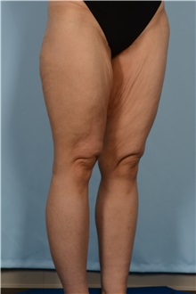 Thigh Lift Before Photo by Ellen Janetzke, MD; Bloomfield Hills, MI - Case 51451