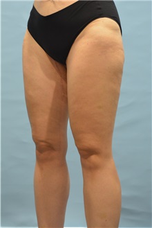 Thigh Lift After Photo by Ellen Janetzke, MD; Bloomfield Hills, MI - Case 51451