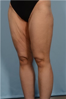 Thigh Lift Before Photo by Ellen Janetzke, MD; Bloomfield Hills, MI - Case 51451