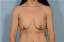 Breast Augmentation Before Photo by Ellen Janetzke, MD; Bloomfield Hills, MI - Case 51452