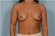 Breast Augmentation Before Photo by Ellen Janetzke, MD; Bloomfield Hills, MI - Case 51454