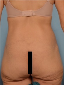 Body Lift After Photo by Ellen Janetzke, MD; Bloomfield Hills, MI - Case 49322