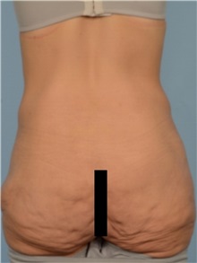 Body Lift Before Photo by Ellen Janetzke, MD; Bloomfield Hills, MI - Case 49322