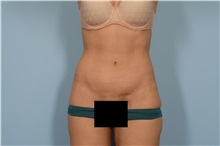 Tummy Tuck After Photo by Ellen Janetzke, MD; Bloomfield Hills, MI - Case 49315