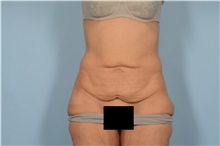 Tummy Tuck Before Photo by Ellen Janetzke, MD; Bloomfield Hills, MI - Case 49315