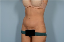 Tummy Tuck After Photo by Ellen Janetzke, MD; Bloomfield Hills, MI - Case 49315