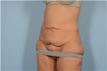 Tummy Tuck Before Photo by Ellen Janetzke, MD; Bloomfield Hills, MI - Case 49315