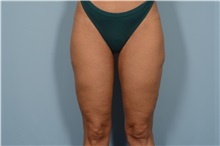 Thigh Lift After Photo by Ellen Janetzke, MD; Bloomfield Hills, MI - Case 49316