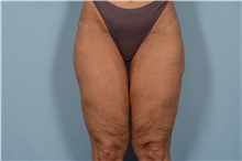 Thigh Lift Before Photo by Ellen Janetzke, MD; Bloomfield Hills, MI - Case 49316