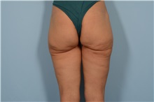 Thigh Lift After Photo by Ellen Janetzke, MD; Bloomfield Hills, MI - Case 49316